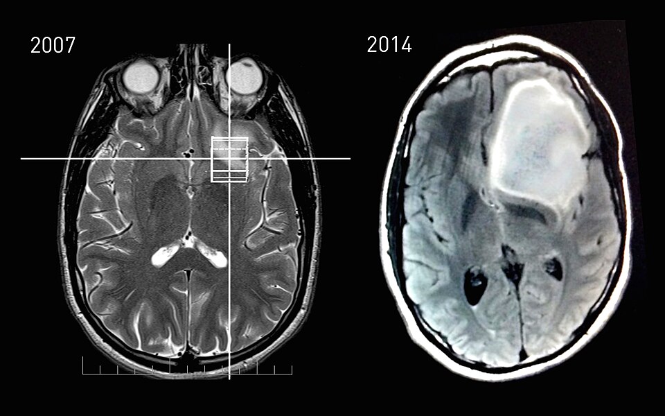 Aidoc Takes Generative AI to the FDA: 'First Read' Would Dra